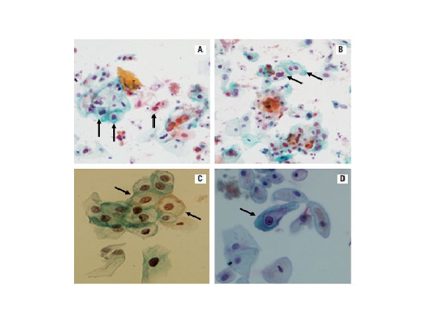 Presence of koilocytes in UC. A and B: 20×; C and D: 40×, optical microscopy, Papanicolaou staining. Images by Leon, RM UC: urine cytology test.