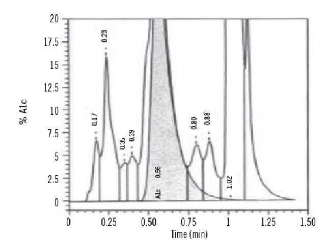 HPLC (variant II, Beta-Thalassemia Short Program) revealed an increased P3 peak (29.2%) with low HbA (58.1%), and normal HbA2 and HbF (2.1% and 1% respectively). A further analysis with alkaline agarose gel electrophoresis (Interlab G26), revealed an abnormal band anodal to A band. These findings were suggestive of hemoglobin variant, probably Hb J