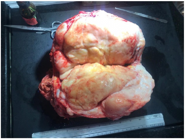 Surgical resection of the tumoral lesion