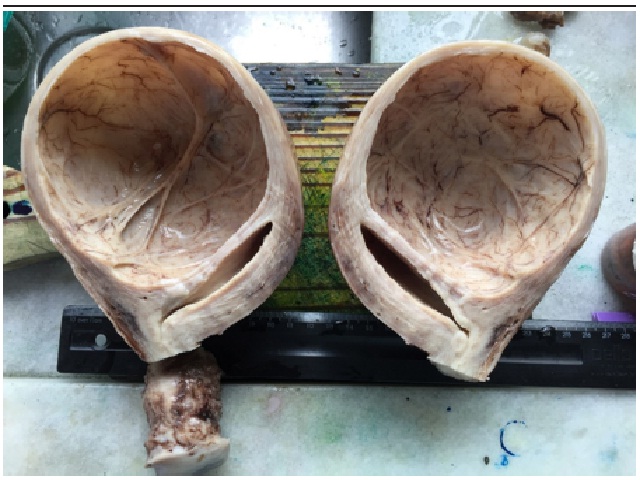 Aspecto macroscópico do tumor fixado em formalina