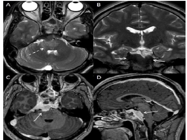 Imagens obtidas do exame de ressonância magnética Sequências axial T2 (A), coronal T2 (B), axial T1 pós-contraste (C) e sagital T1 pós-contraste (D). Lesão meníngea retroclival com marcado hipossinal em T2 (setas em A e B); há compressão sobre o tronco cerebral, causando edema, com hipersinal em T2 (seta tracejada em A); nota-se realce intenso ao contraste nas sequências T1 pela lesão (setas em C e D).