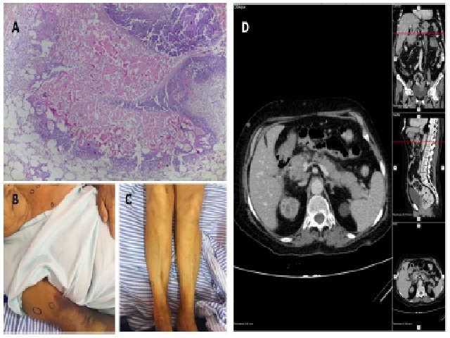 A) paniculite lobular com infiltrado inflamatório, extensa necrose, restos celulares e saponificação com adipócitos fantasmas, compatível com PP (HE, 40×); B e C) paciente com lesões nodulares assintomáticas, por vezes eritematosas, disseminadas pelo tronco e pelos membros superiores e inferiores; D) TC apresentando pâncreas espessado, com densificação do parênquima e gordura pancreática. Nódulos com densidade de partes mole no tecido subcutâneo