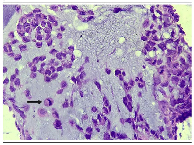 Imagem microscópica (400×) de metástase para o pulmão, com detalhe citológico da neoplasia, contendo mitoses (seta)