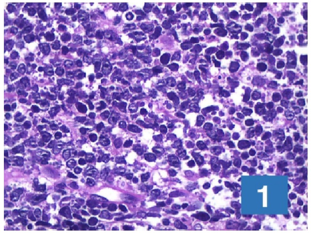 Skin sections showing epidermal hyperplasia, swollen papillary dermis, and extensive infiltration by atypical lymphocytes in the reticular and deep dermis, amid rounded and small structures distributed in the extracellular dermis. 40× lens