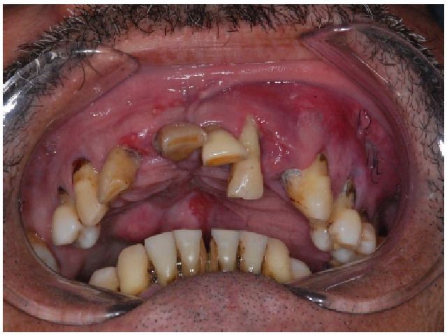 Intraoral evaluation showing swelling on the hard palate, left side, erythematous mucosa, and poorly positioned teeth