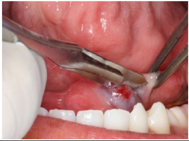 Performing a surgical procedure, with the purpose of marsupialization of the lesion and removal of tissue (biopsy) for histopathological analysis