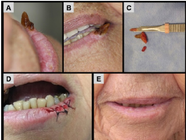 Clinical image shows: A) solitary, asymptomatic, slowly enlarging, and cylindrical growth in the lower lip; B) lesion in the first appointment; C) surgical specimen; D) immediate post-operative aspect; E) two-years follow-up