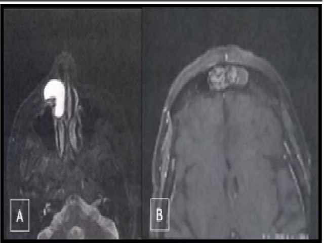 MRI images