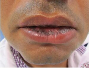 Brownish macules, of ill-defined borders, in lower and upper lip