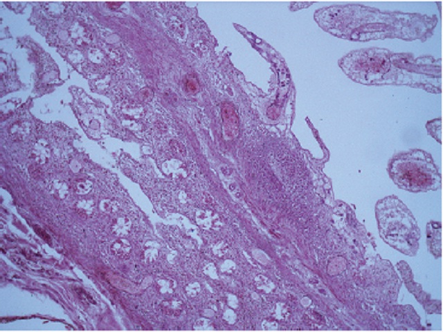 Histological section of jejunum with transmural coagulative necrosis, HE 100× HE: hematoxylin and eosin.