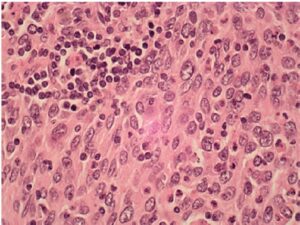 High magnification shows that the neoplastic cells are epithelioid with ovoid to elongated bland nuclei, distinct nucleolus and eosinophilic cytoplasm.