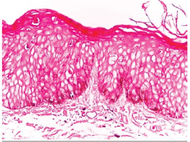 Histopathology,400×Fontana- Masson: Fontana Masson stain enhances melanin pigment. Melanin pigmentation is observed in the basal layer, focally in