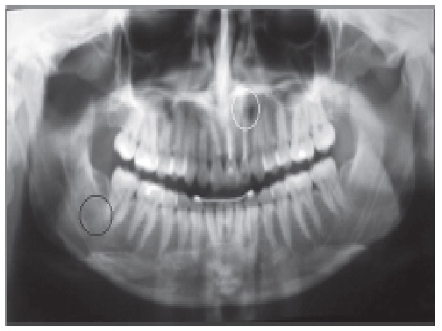 − Panoramic radiograph prior to treatment: