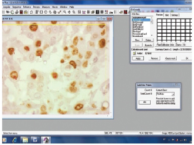 Image of screen capture of Image Pro Plus 6.0 software with the file of cells brown stained with Ki-67 antibody. Each field had the number of cells and the stained area counted. DAB dye, 400×