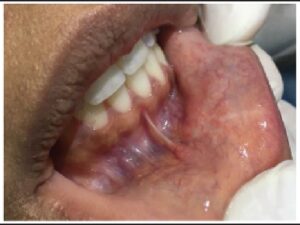Clinical aspect of the patient’s lower labial mucosa two years after surgical removal of the lesion, with no signs of relapse