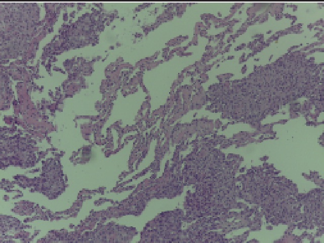 Proliferation of epithelioid cells forming vascular spaces of varying sizes, sometimes with papillary hyperplasia in the lumen (HE, 100×)