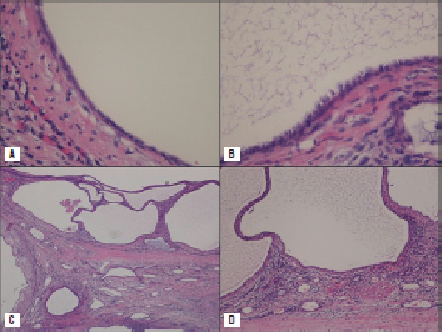 The cysts were lined by cubic or flat epithelia, sometimes with hobnail cells