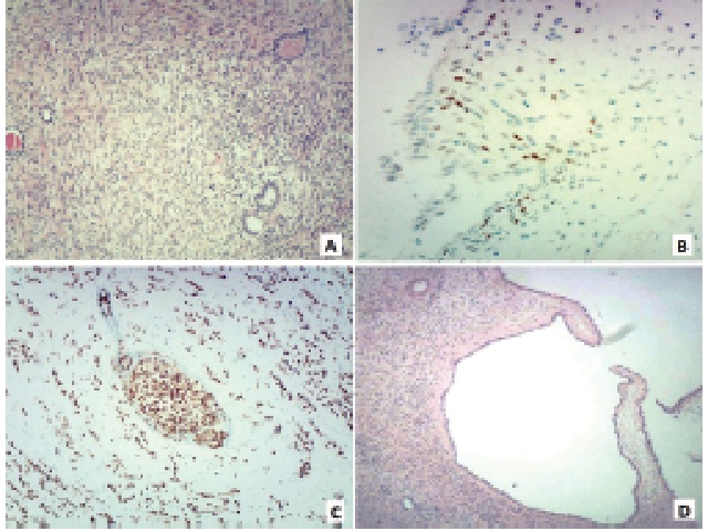 Mixed epithelial and stromal tumor A) a biphasic tumor composed by spindle cells and epithelial elements; B) positive