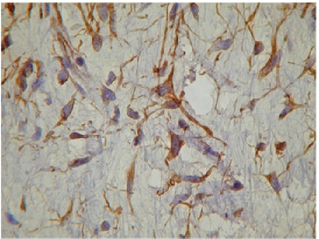 Immunohistochemistrystudy showing only positive tumor cells for vimentin (400×)