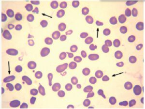 Peripheral blood smear showing presence of schistocytes (400×)