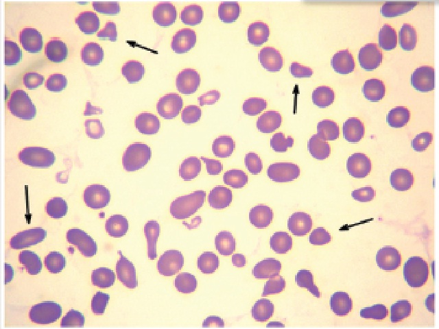 Peripheral blood smear showing presence of schistocytes (400×)