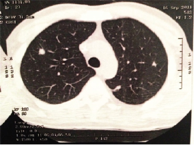 Chest CT scan: bilateral pulmonary nodules