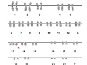 Skin karyotype of the patient. The arrow indicates the additional chromosome 13, a finding compatible with full trisomy 13 or Patau syndrome