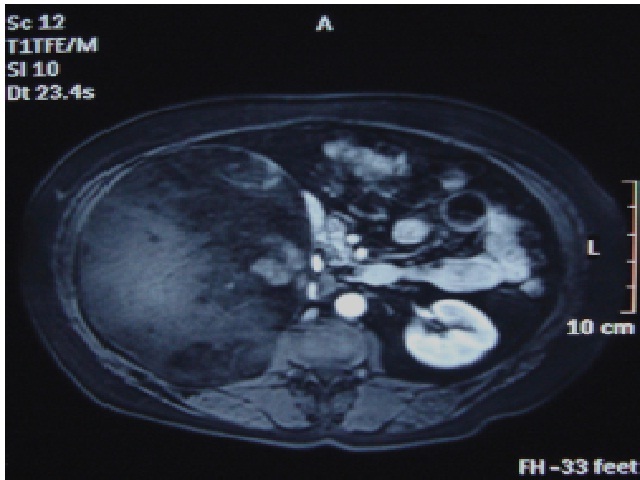 Axial slice of abdomen MRI showing a large well-defined expanding solid cystic lesion, with areas of both hyper- and hypo-intense signal on T1 with contrast enhancement