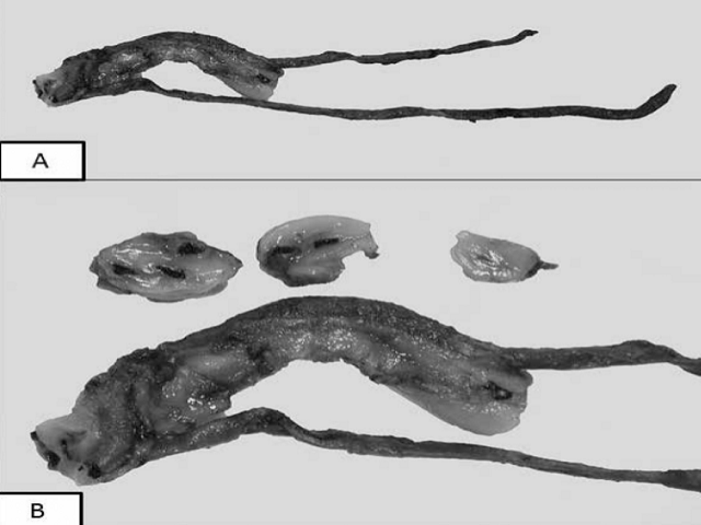 (A and B) - Linear disruption of Wharton’s jelly of the umbilical cord.