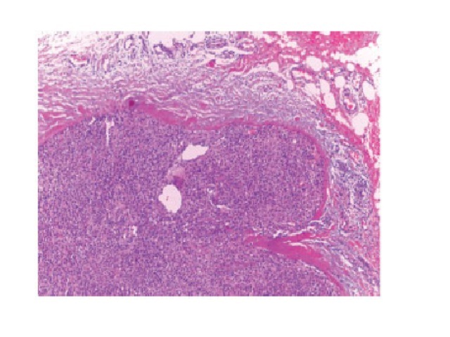 Histopathology, 100× HE: encapsulated lesion composed of small round cells HE: hematoxylin and eosin stain.