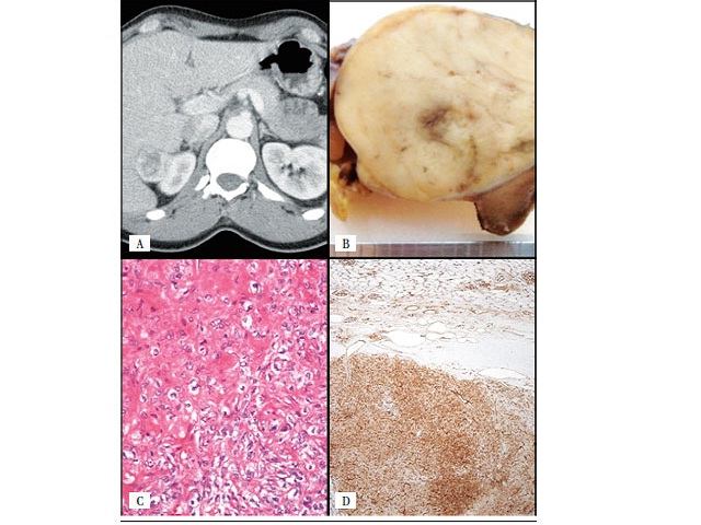 A) peripheral right tumor on CT scan; B) gross examination revealed a brown and capsulated lesion; C) histologically it was composed of elongated cells, with little atypia, intercalated by collagen bundles; D) the tumor cells were positive for CD34 CT: computed tomography.