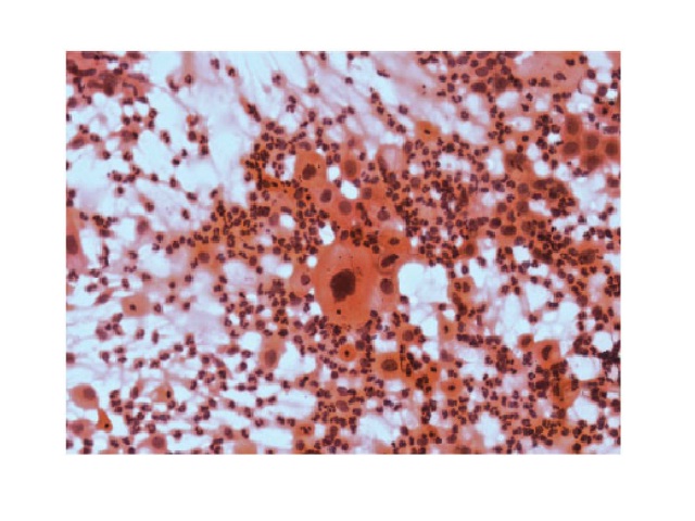 Dyskaryotic smear cytology of a 67-year-old patient Squamous cells present in an atrophic smear. Presence of polymorphonuclear leukocytes in the slide background with granular material that resembles tumor diathesis (Papanicolaou, 400×).