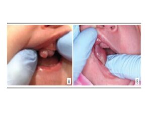 Clinical aspect A and B) clinical aspect of the lesion evidencing a nodule in the alveolar ridge of the anterior maxilla region.