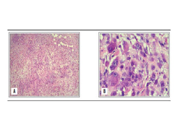 Pathology study with regular HE staining A) low magnification image; B) higher magnification shows markedly proliferative cellular atypia with a myxoid matrix and a high mitotic index. HE: hematoxylin and eosin.