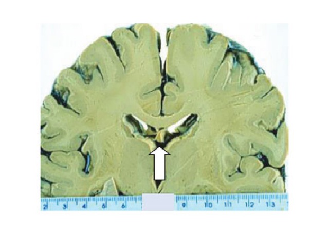 Macroscopic aspect of brain and heart obtained from autopsied patients with cysticercosis, from 1990 to 2018 (arrows)