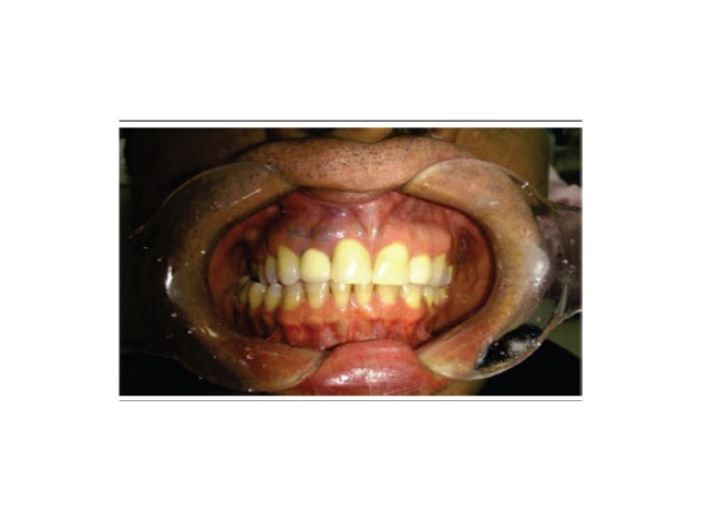 Clinical aspect Intraoral aspect of the patient, evidencing a purplish increased volume, located in the gingival region of the maxilla, in the area adjacent to the apex of the element 12.