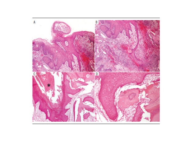 he microscopic analysis showed intense well-differentiated squamous epithelial proliferation, with frequent invaginations (A, 5×). The fibrovascular stroma showed numerous inflammatory cells (B, 5×). Notice the large area of keratin deposition (asterisk), foci of osseous resorption in close relationship with florid squamous epithelial proliferation with prominent invagination (C, 5× and D, 20×). Hematoxylin and eosin stain