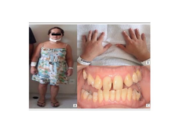 Extraoral and intraoral clinical features of patient case 2 A) patient with short stature and stunted extremities; B) shortened phalanges; C) biprotrusion, bilateral posterior open bite, enamel hypoplasia, dental agenesis and rotated premolar.