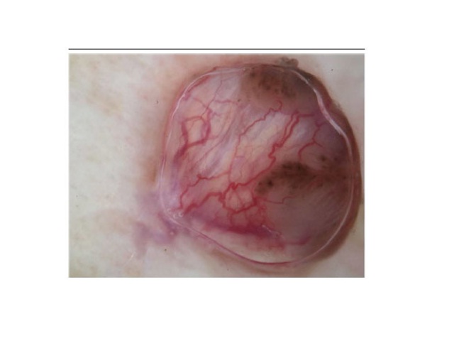 Lesion in dermoscopy