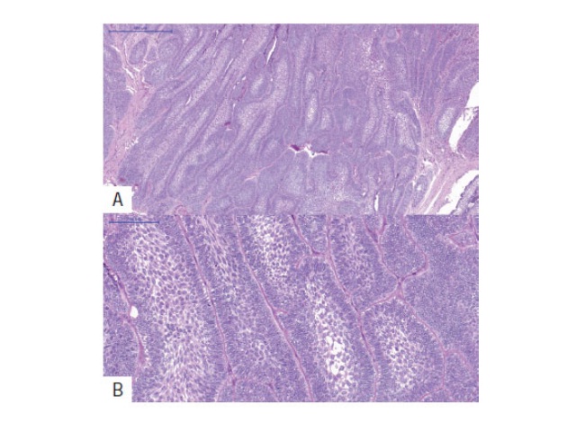 A) multiple nests and strands of odontogenic epithelium demonstrating peripheral columnar differentiation with reverse polarization. Central zones resemble stellate reticulum (HE, 500 μm); B) higher magnification highlights the peripheral columnar cells exhibiting reverse polarization (HE, 100 μm)