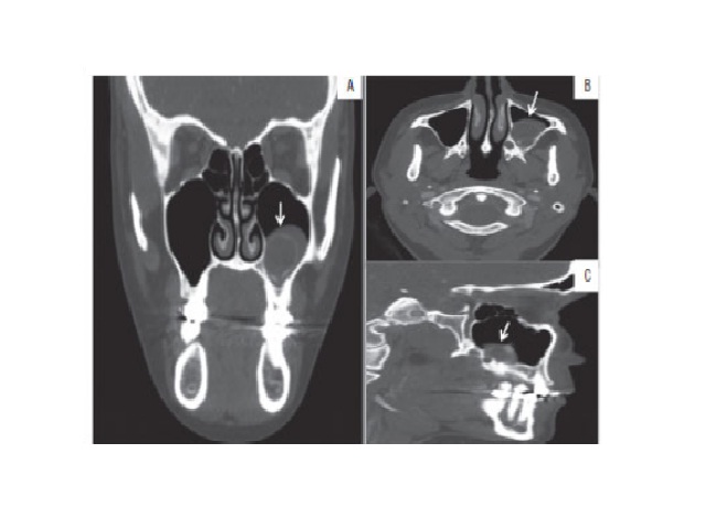 Computed tomography A) coronal section; B) axial section; C) sagital section