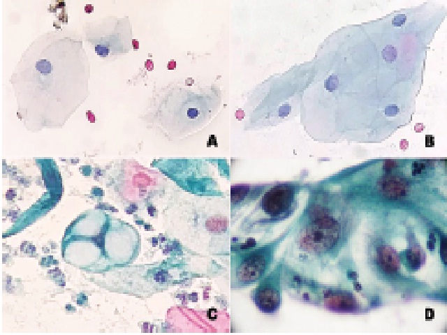 Benign reactive cellular changes associated with radiation