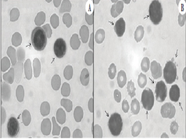 Morphology of B lymphoid precursors (arrows) in BM aspirate samples stained by May-Grünwald-Giemsa