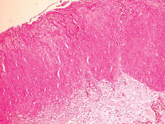 Histological section of anal canal with immature cells occupying more than the lower twothirds of the epithelium with a thin layer of atypical maturating cells on the surface.