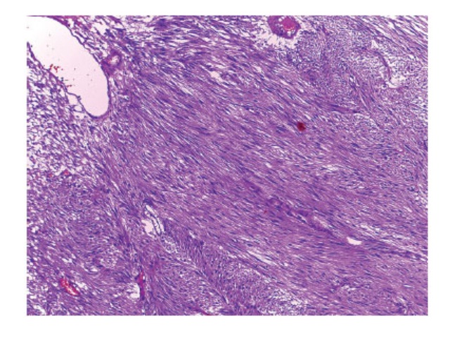 Microscopy, 400×, HE: spindle cells, with elongated nuclei and abundant cytoplasm HE: hematoxylin and eosin.