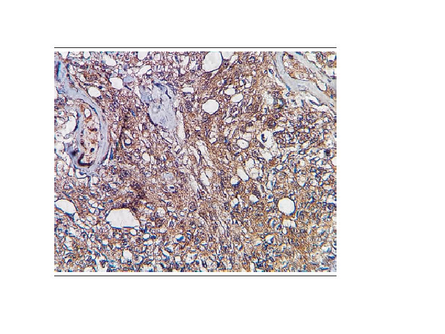 Immunohistochemical reaction for IFN-γ (20× magnification); diffuse positivity in lesion cells Source: prepared by the author. IFN-γ: interferon-gamma.