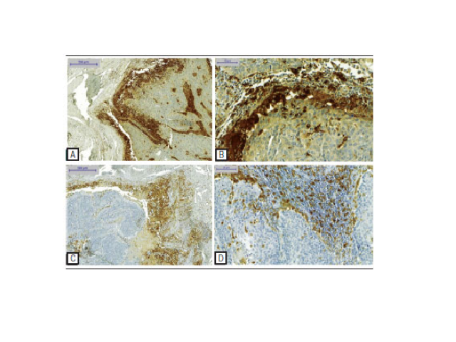 SCC of the tongue Intense immunohistochemical expression of CD68 (A and B) and CD163 (C and D), showing compressive invasion pattern, with outlined infiltrating border adjacent to abundant inflammatory infiltrate (Panoramic Viewer, Advance). SCC: squamous cell carcinoma.