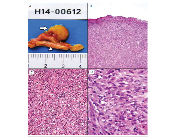 Gross and microscopic examination: pathological findings of inflammatory myofibroblastic tumour