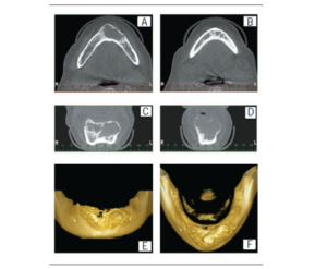 Axial, coronal, sagittal and 3D images Expansive hypodense lesion in the mandibular symphysis and parasymphysis