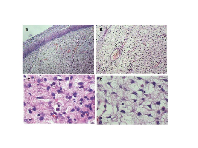 AAM in HE staining revealing a fragment of squamous mucosa with spindlecell neoplastic proliferation in loose collagenous stroma with a myxoid matrix embedding irregular vessels and inflammatory cells. A) 40×; B) 100×; C) 400×; D) 400× AAM: aggressive angiomyxoma; HE: hematoxylin and eosin.